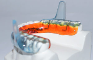 sleep apnea oral device west orange new jersey